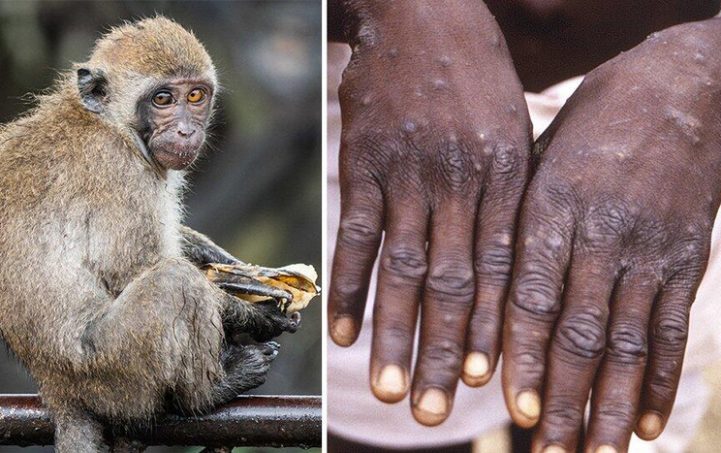 В Китае произошло два случая заболевания оспой обезьян